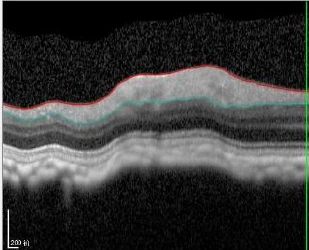 Glaucoma Modello di malattia dei primati non umani